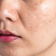 pigmentation