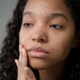 ACNE SCARS